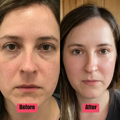 Visera Lens™ Red Light Eye Therapy